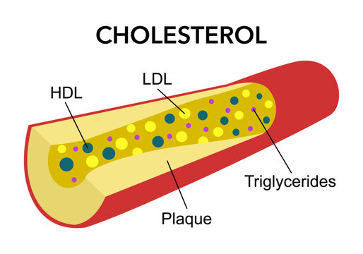 Cholesterol in blood vessel in flat design. HDL, LDL, triglycerides.