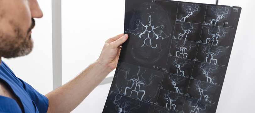 Doctor radiologist inspects MRI image of blood vessels of head, analyzing details to determine patient's condition and possible treatment strategies