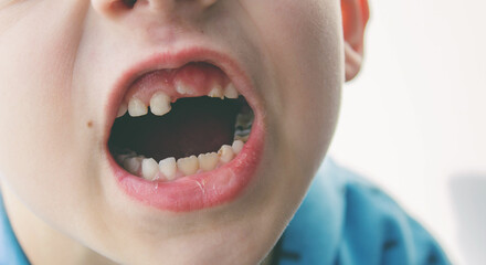 Dental medicine and healthcare - baby teeth with caries