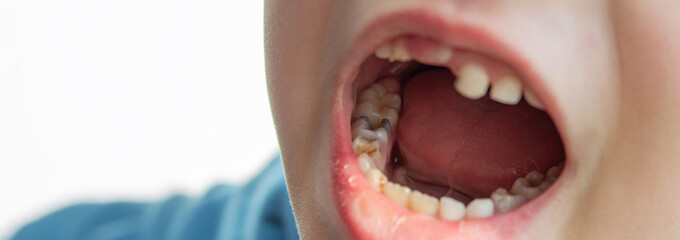 Dental medicine and healthcare - baby teeth with caries
