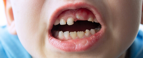Dental medicine and healthcare - baby teeth with caries