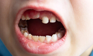 Dental medicine and healthcare - baby teeth with caries