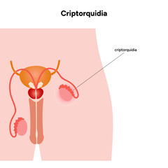 Obraz premium Criptorquidia Testicular disease. Man cryptorchidism pain testicle pathology problem. Medical diagram 