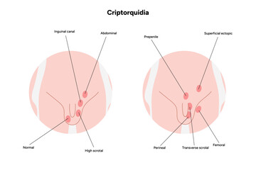 Criptorquidia Testicular disease. Man cryptorchidism pain testicle pathology problem. Medical diagram 