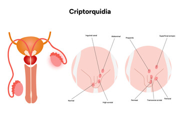 Criptorquidia Testicular disease. Man cryptorchidism pain testicle pathology problem. Medical diagram 