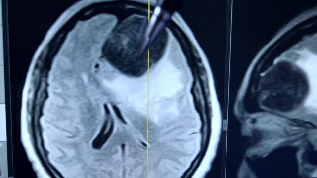 A pen points at the screen with MRI scan of the head. Unrecognized medic points at the tumor before surgery on brain. Close up.