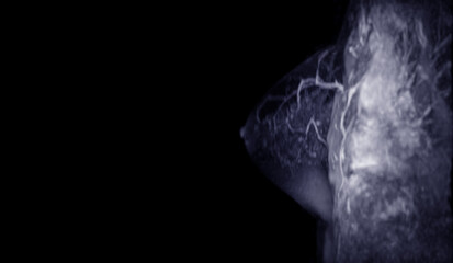 Naklejka premium MRI scan of the breasts in an sagittal view with contrast enhancement.