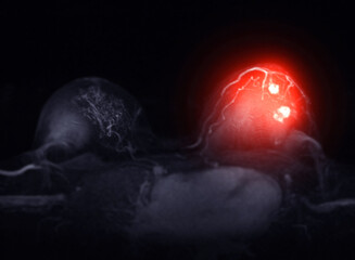 MRI scan of the breasts in an axial view with contrast enhancement.