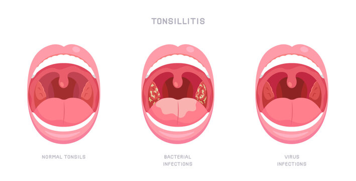 Infographic of sore throat due to bacteria and virus infection. Opened mouth showing of Tonsillitis or tonsil inflammation symptom. Concept of illness, health care, oral disease. Flat vector style.