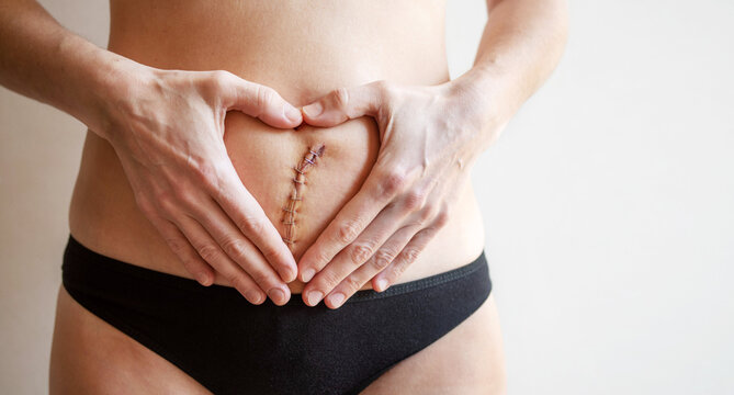 Hands in the shape of a heart on the body of a woman with a surgical stitch on her abdomen sewn with metal staples after a gynecological operation hysterectomy or laparotomy, close-up, copy space