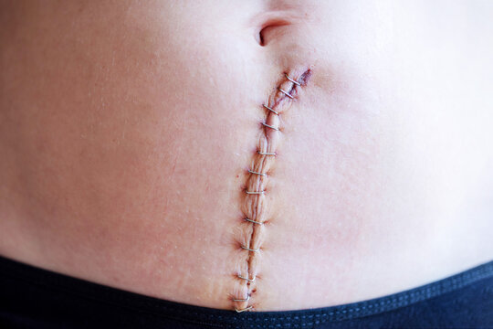 Woman's body with a surgical scar on her abdomen stitched with metal staples after a gynecological operation hysterectomy or laparotomy, or after giving birth by cesarean section, close-up