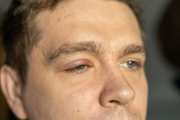 Selective focus on swollen and painful red upper eye lid with onset of stye infection due to...