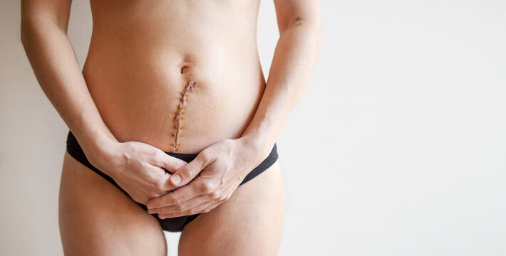 Woman's body with a surgical scar on her abdomen stitched with metal staples after a gynecological operation hysterectomy or laparotomy, or after giving birth by cesarean section, close-up, copy space