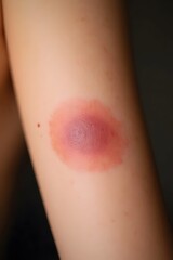Fototapeta premium Inflamed insect bite on skin showing red swelling and irritation