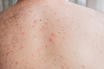 Fototapeta premium Adult man half face with strong aggressive varicella or chicken pox. Pink spots, papules, vesicles. 