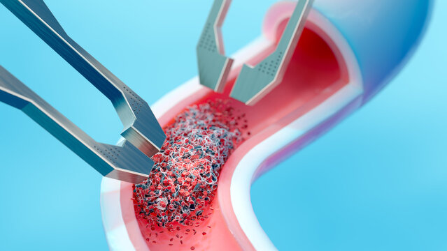 Microgripper devices removing blood clot, conceptual illustration