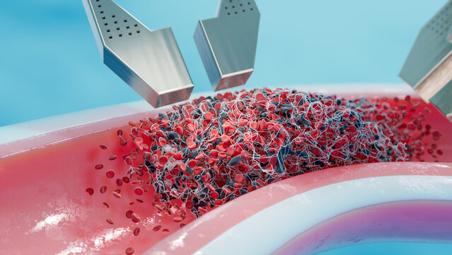 Microgripper devices removing blood clot, conceptual illustration