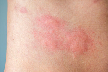 Fototapeta premium Young asian man itching and scratching on his back from allergic itchy dry skin eczema dermatitis insect bites