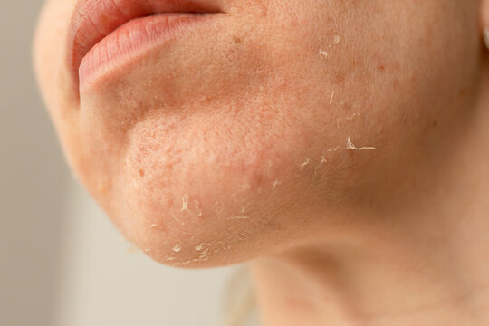 Dry skin condition affecting the chin area observed in a close-up view during daylight hours