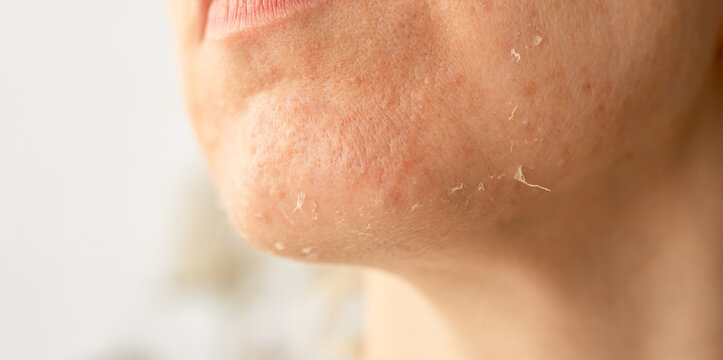 Skin condition highlighting dryness and peeling near chin area in indoor setting during daylight hours