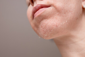 Skin flaking on chin reveals dryness and irritation in a close-up view during indoor lighting