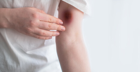 Obraz premium A bruise on a woman's arm after a bicycle accident. Female hand with bruises from an injury, signs of skin damage.