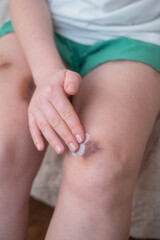 A child applies ointment to bruises after falling off a bike. Caring for skin and health after an injury with bruise treatment.
