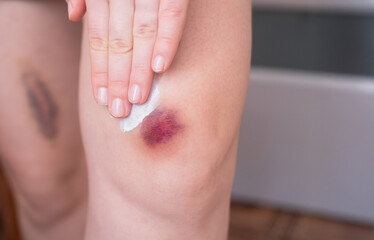 Woman treats bruises on her body. Stress and fatigue weaken the body, affecting blood circulation...