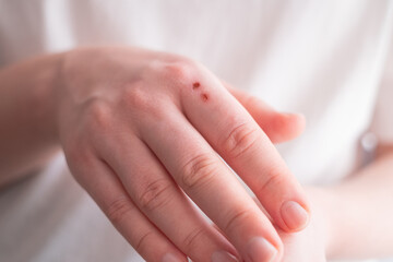 Woman carefully applies ointment to a small wound on her hand, ensuring quick healing.