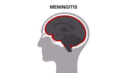 Meningitis medical poster
