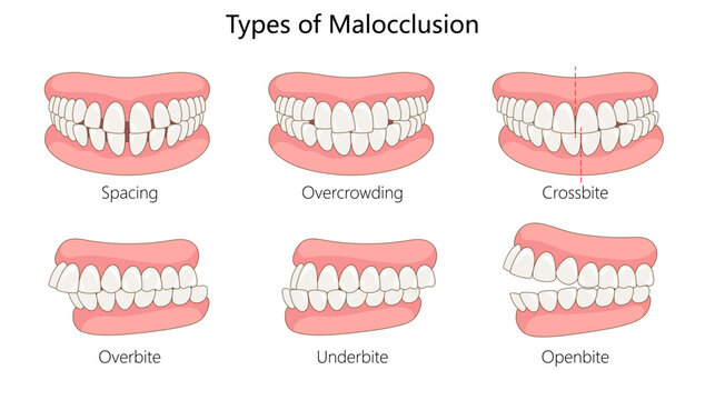 types of malocclusion, including spacing, overcrowding, crossbite, overbite, underbite, and open bite diagram hand drawn schematic vector illustration. Medical science educational illustration