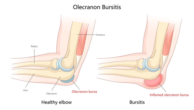 comparing healthy elbow to inflamed olecranon bursa, showing the effects of bursitis on the elbow joint diagram hand drawn schematic vector illustration. Medical science educational illustration
