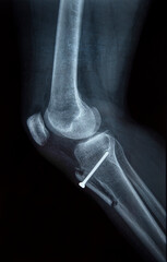 X-ray of a knee with dislocated patella damage and titanium screw prosthesisX-ray of a knee with dislocated patella damage and titanium screw prosthesis