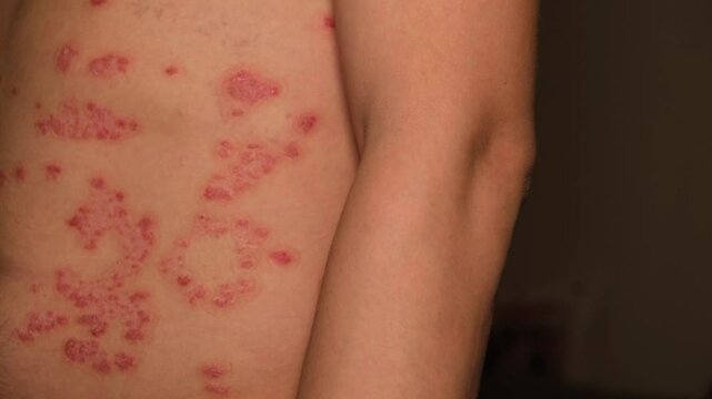 Managing psoriasis symptoms with effective treatment options for healthier skin