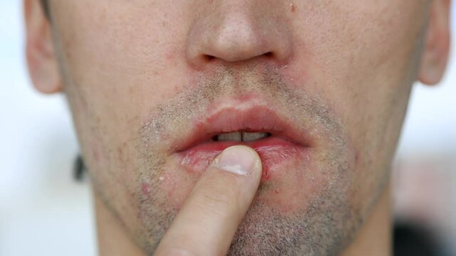 Shot of a man examining his flaky facial skin and dry chapped lips after using acne medication. Highlights side effects like dryness and irritation. Perfect for skincare and acne treatment topics