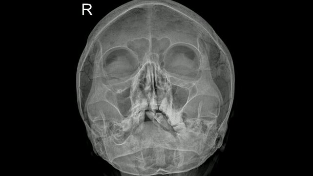 Sinys X-Ray Highlighting Sinus Cavities and Nasal Structure