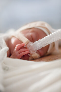 Close-up of baby with nasogastric oxygen tube