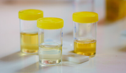 Urine drug test samples in medical containers with test strips on a white table. Laboratory analysis for health diagnostics, drug screening, and medical examination. Concept of substance detection.