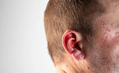 Red rashes and spots on the ears and head of a man after drinking alcohol. Alcoholic dermatitis and...