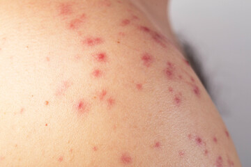 Red spots and rashes on the skin of the back and shoulders after drinking alcohol. Anaphylactic...
