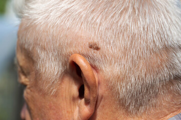 Brown mole on the head of an elderly person, nevus and melanoma, close-up, dermatology