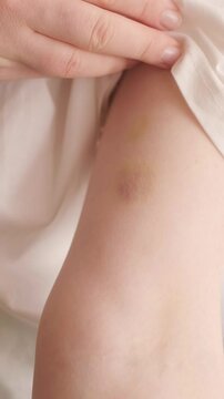 A woman applies heparin ointment to a bruise on her hand to reduce swelling. Female hand with hematomas after injury, recovery process.