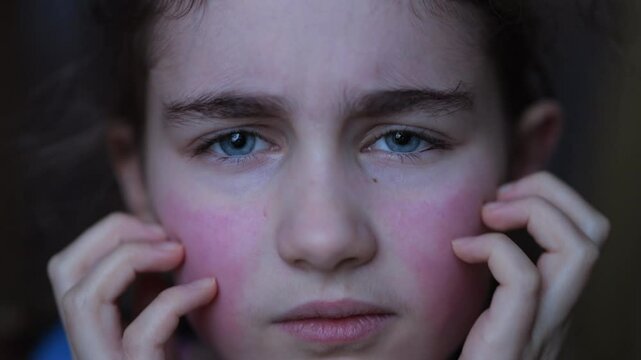 Girl Has Dry Red Skin and Scratching Her Face. Child Scratches Atopic Skin. Dermatitis, Diathesis, Allergy on Child Body and Face. Irritation and Pruritus. Kid Having Allergic Reaction on Skin to Food