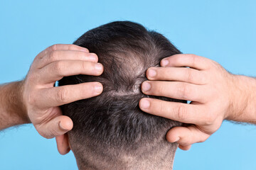 Fototapeta premium Baldness problem. Man with bald spot on light blue background, back view