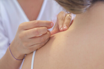 Acupuncture for a young woman. Traditional Chinese medicine