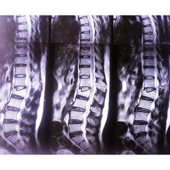 MRI scan of lumbosacral (LS) spine, case of lumbar spondylosis and osteoporotic vertebral...