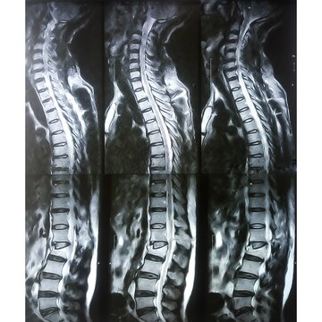 MRI scan of lumbosacral (LS) spine, case of lumbar spondylosis and osteoporotic vertebral compression fractures (OVCF).