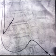X ray image showed dual chamber permanent pacemaker (PPM) leads in left chest at Cath Laboratory.