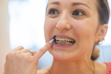 Portrait of a Caucasian woman with braces on her teeth. The girl adjusts the rubber band on her...