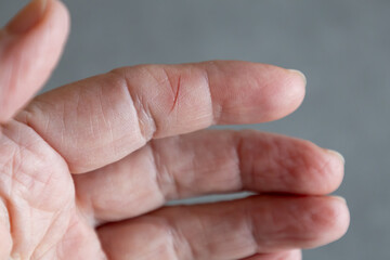 close-up of a finger with a small cut